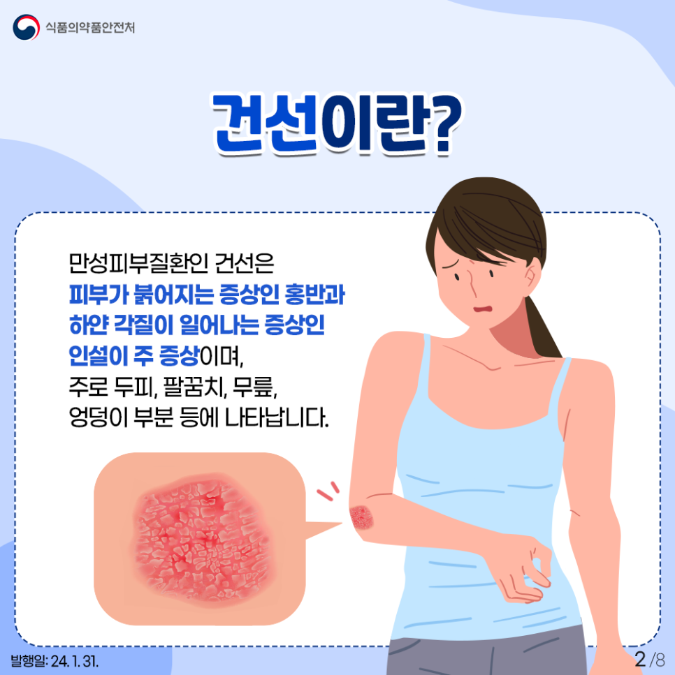 #2 건선이란? 만성 피부질환인 건선은 피부가 붉어지는 증상인 홍반과 하얀 각질이 일어나는 증상인 인설이 주 증상이며, 주로 두피, 팔꿈치, 무릎, 엉덩이 부분 등에 나타납니다.